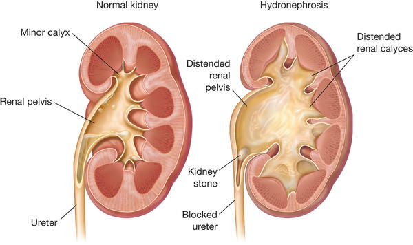 what does an ultrasound of kidney stones look like can you see a kidney stone on an ultrasound