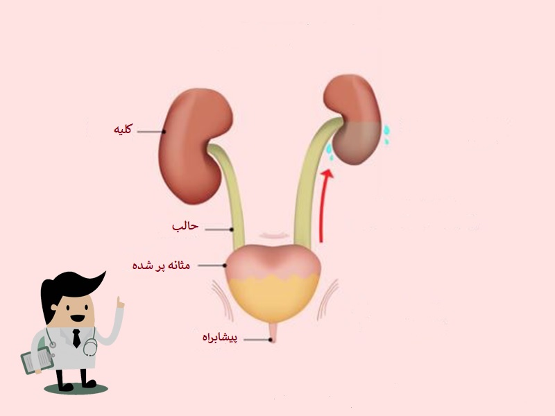 hydronephrosis