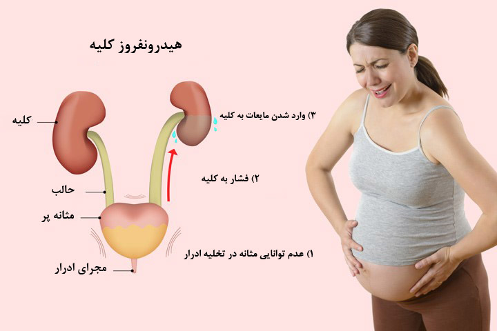 هیدرونفروز چیست؟
