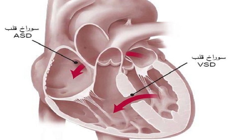 سوراخ قلب یا بیماری نقص دیواره بین ‌بطنی چیست؟