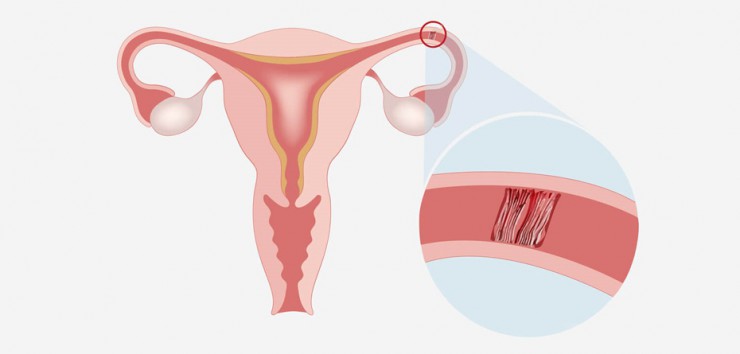درمان طبیعی انسداد لوله‌های رحمی