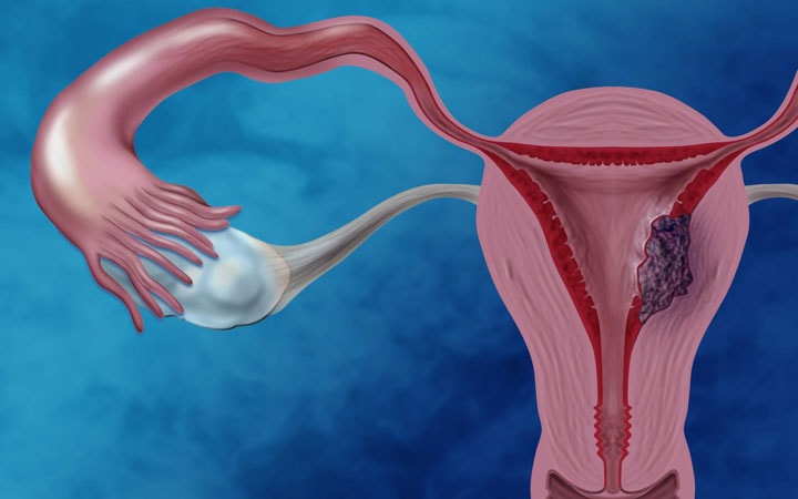 uterus-cancer