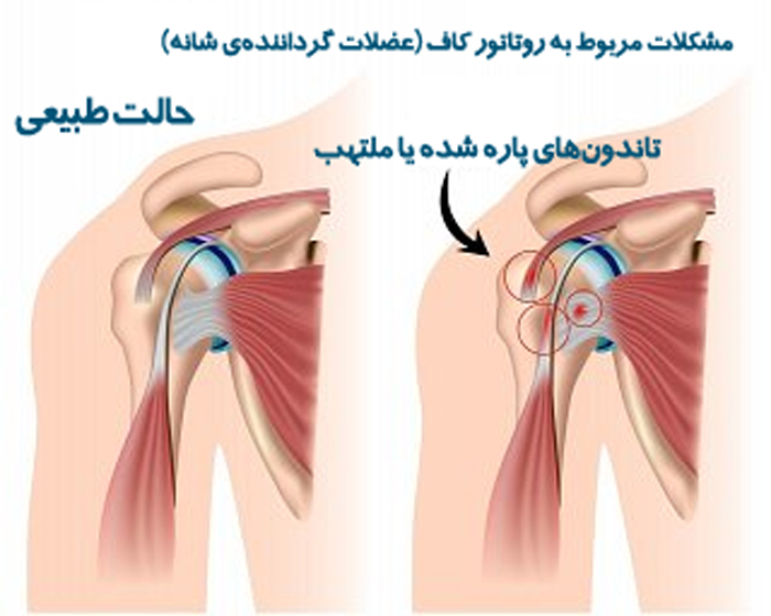 تاندون-شانه