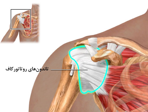 تاندونیت