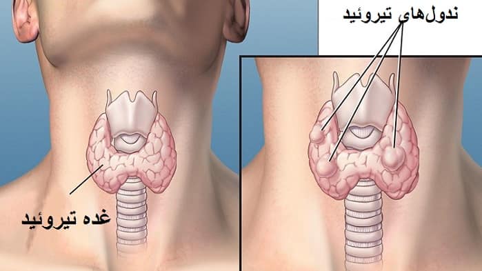 ندول-تیروئید-درمان-گره-تیروئید-کم-کار-و-پرکار-با-دارو-و-جراحی-min