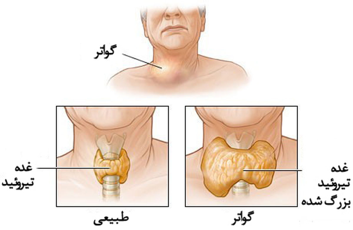 گواتر