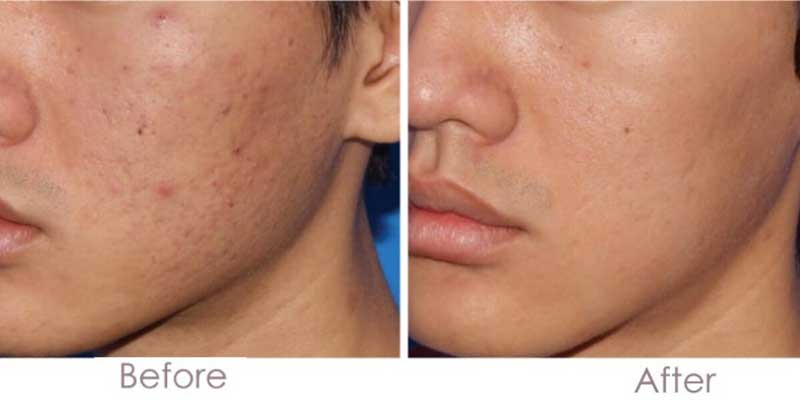 before-and-after-microneedling-3