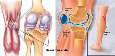 knee-bakercyst1-1