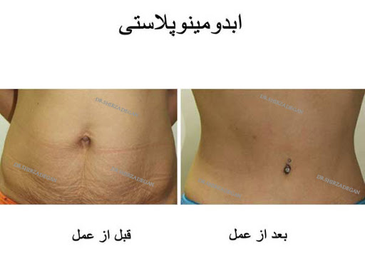 جراحی شکم