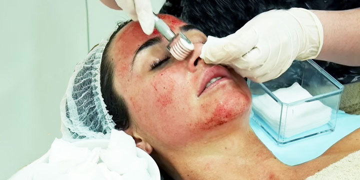 میکرونیدلینگ دستی