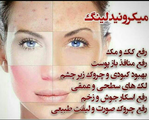 میکرونیدلینگ2
