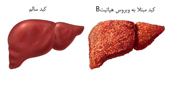هپاتیتB