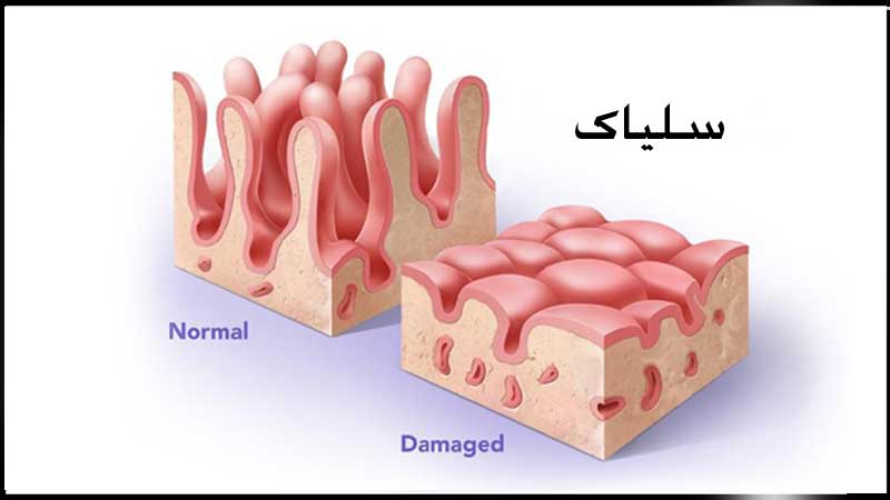 coeliac-disease