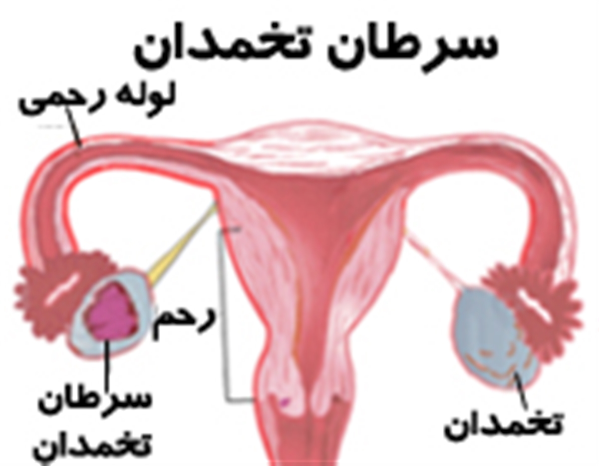 سرطان