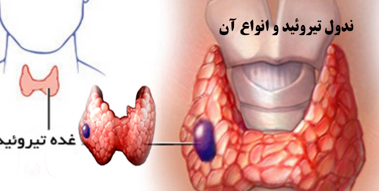 غده-تیروئید