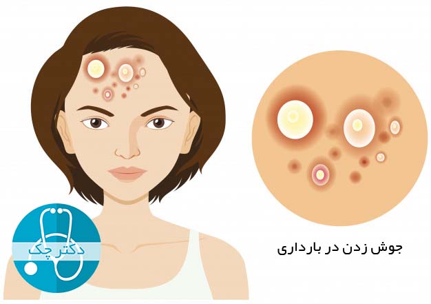 diagram-showing-woman-with-acne-problem_