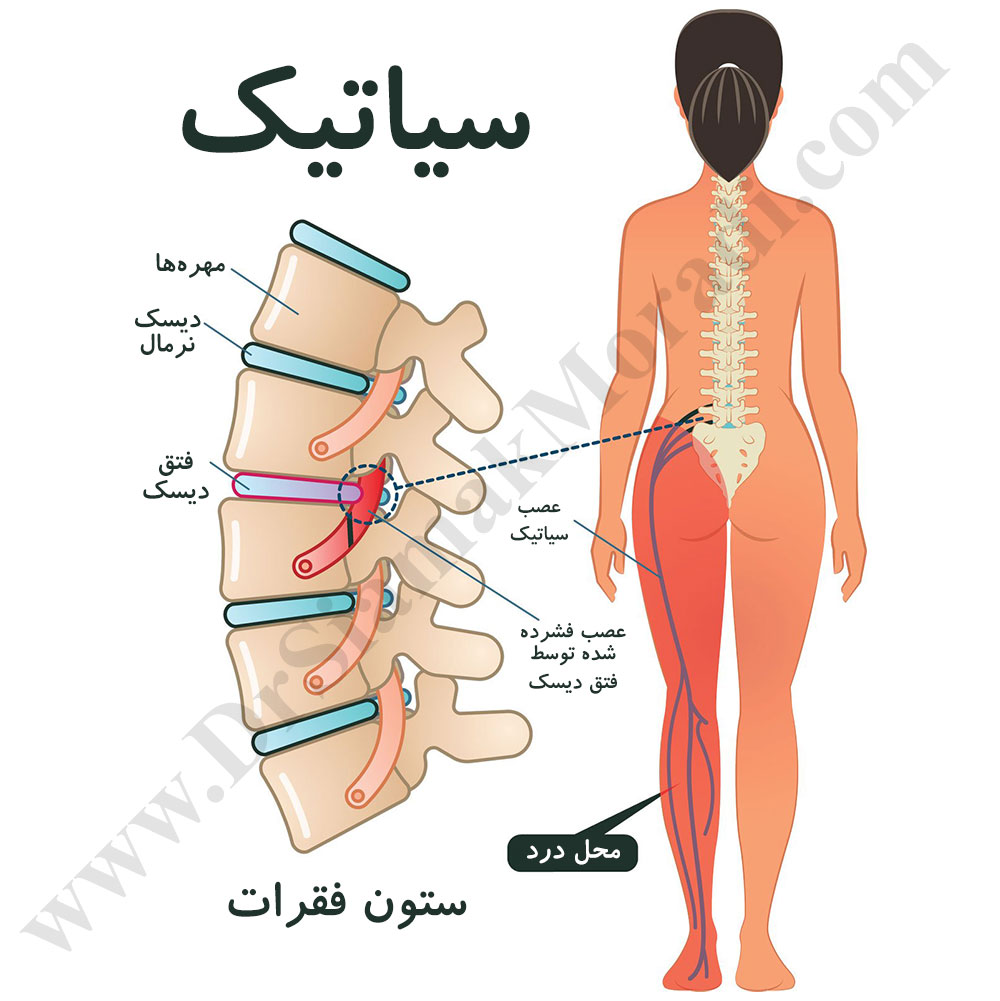 درد-عصب-سیاتیک