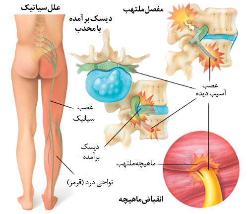 سیاتیک