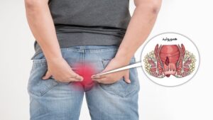 hemorrhoid-1