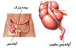 آپاندیس