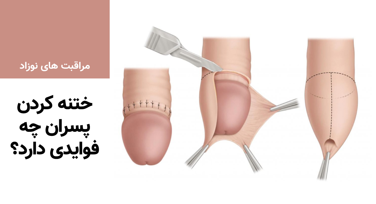 ختنه کردن پسران