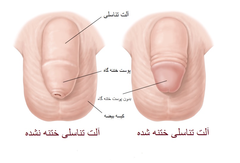 ختنه کردن پسران