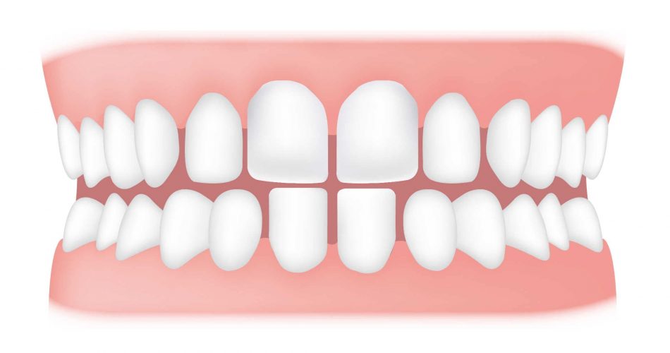فاصله بین دندان