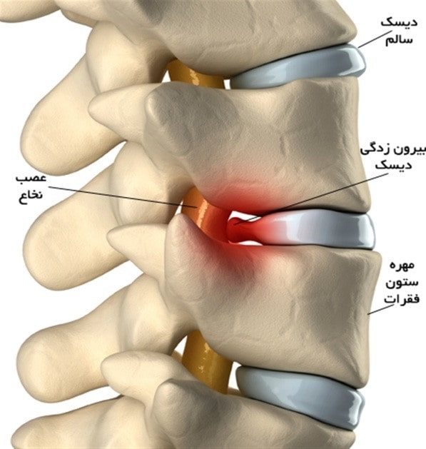 درمان خانگی دیسک کمر