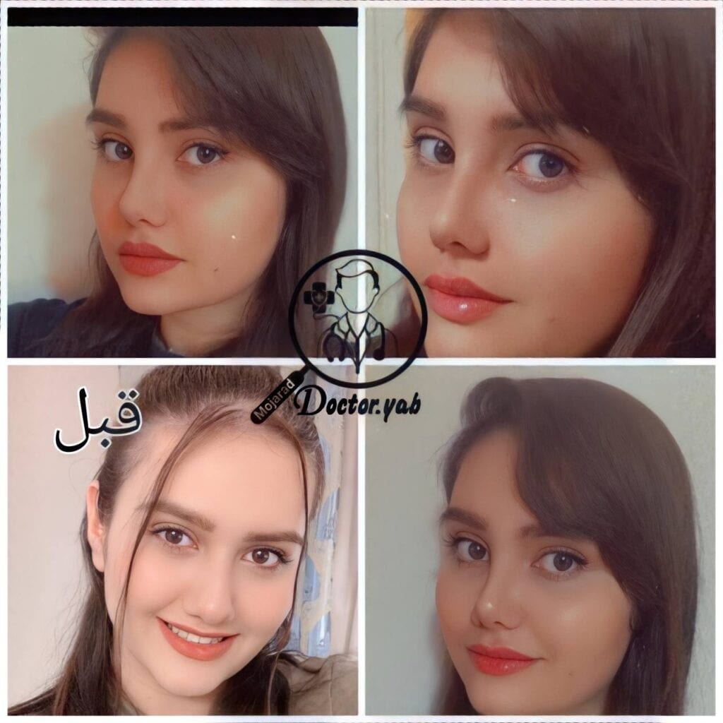ترفندهای کاهش ورم بینی