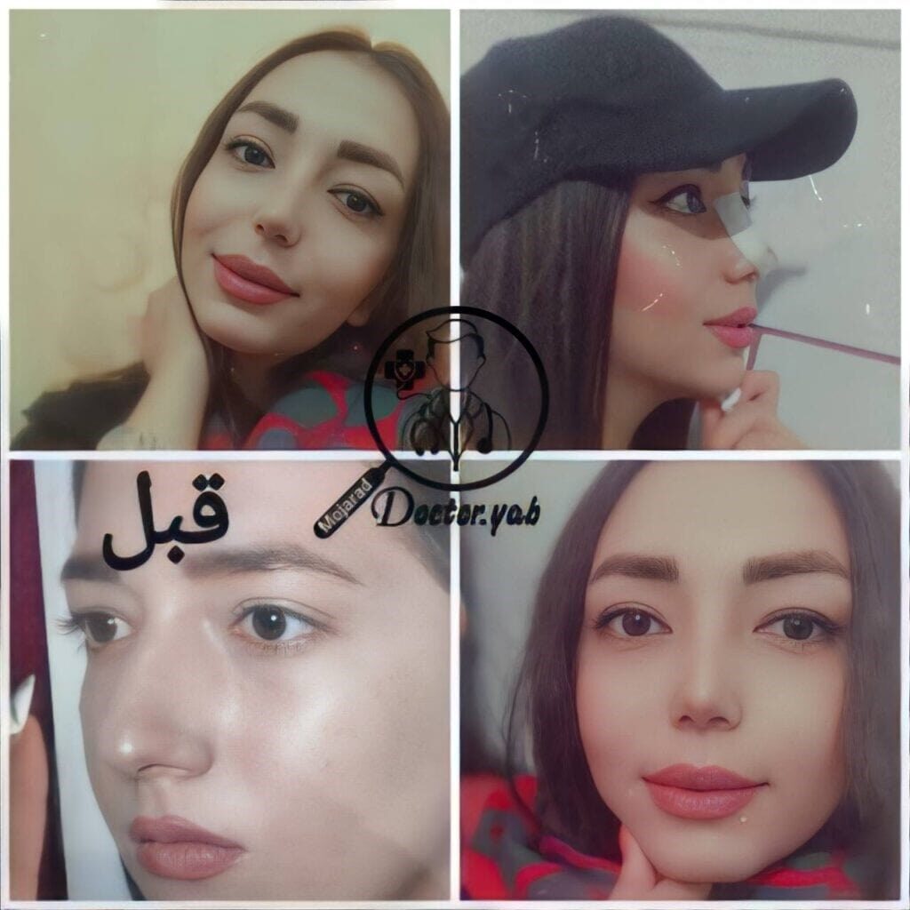 ترفندهای کاهش ورم بینی