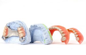 تفاوت دندان مصنوعی و ایمپلنت چگونه است ؟