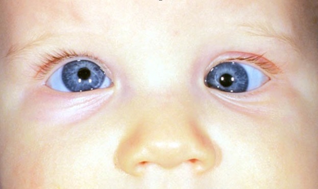 انحراف چشم چیست و جراحی آن چه خطراتی دارد؟