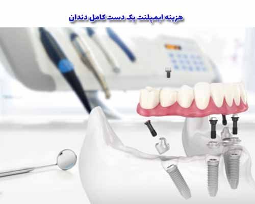 قیمت ایمپلنت دندان در ایران در 1402