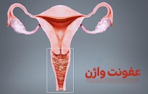 برای جلوگیری از عفونت واژن چه باید کرد؟