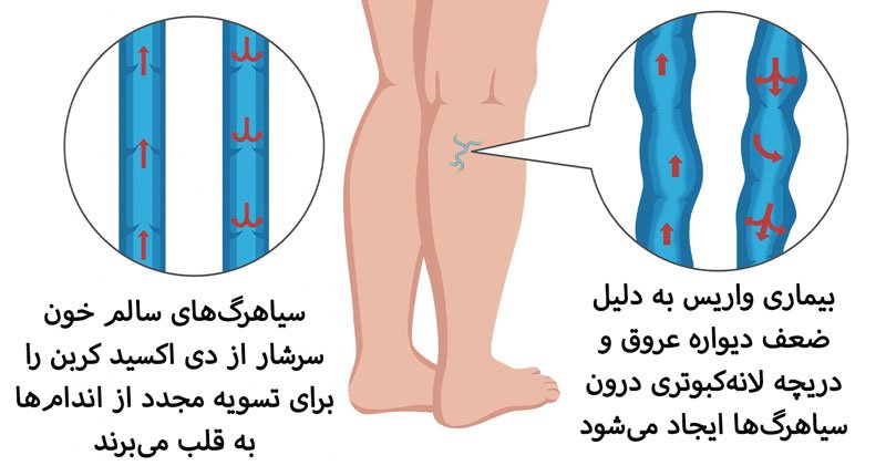 علت بیماری واریس