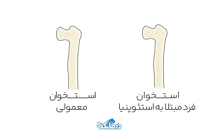 علائم تراکم استخوان