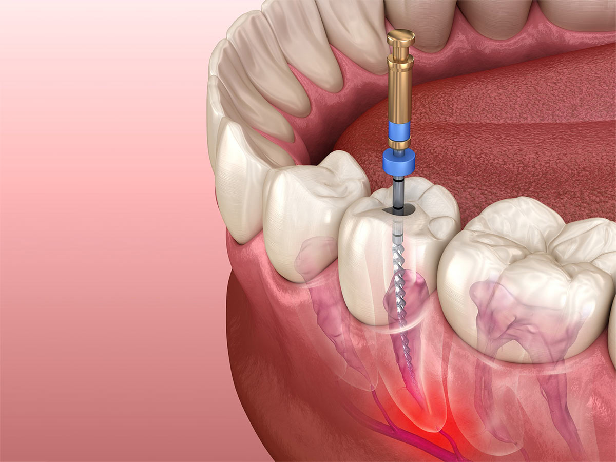 Toothache after nerve extraction