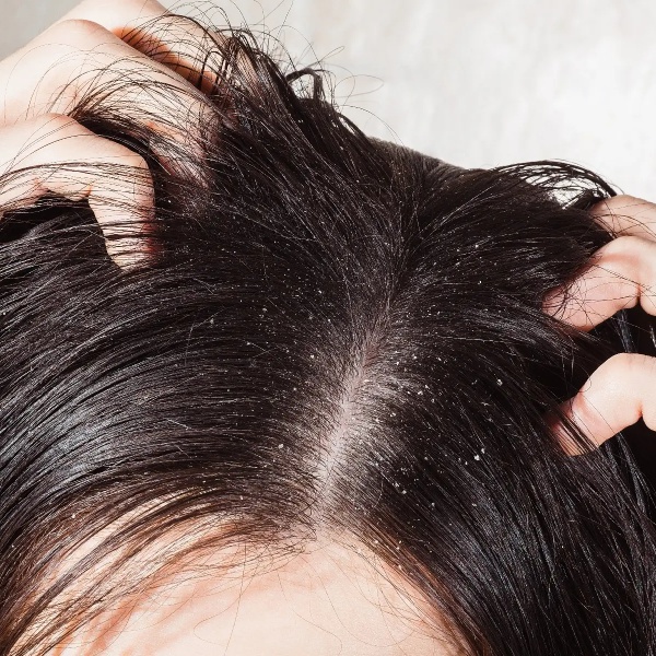 The cause of dandruff