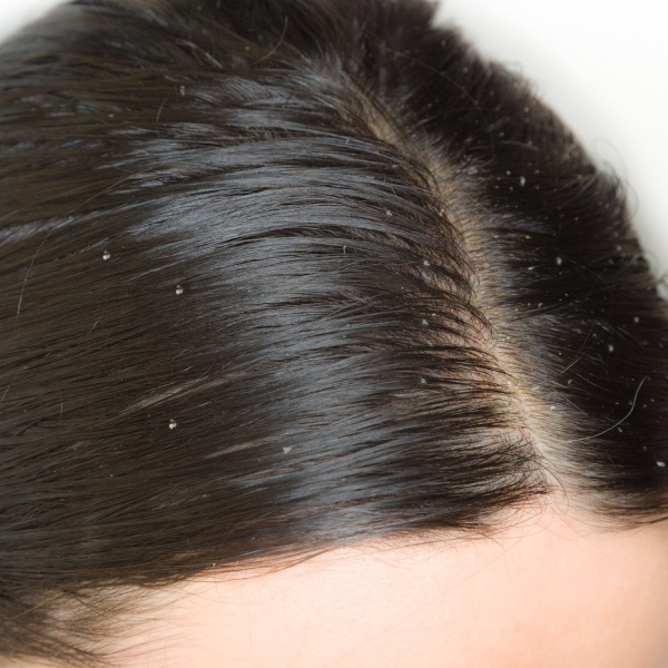 The cause of dandruff