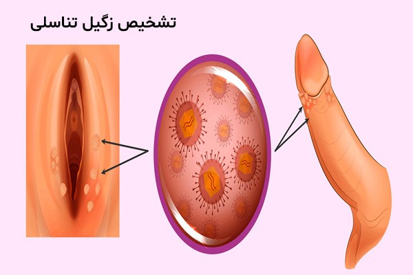 زگیل تناسلی 