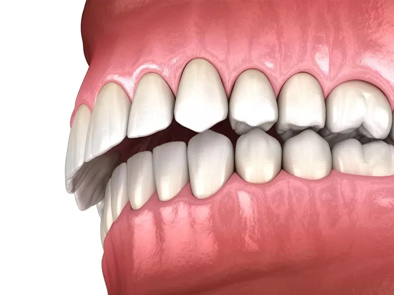 اردتونسی فک پایین برای جلوکشیدن فک پایین