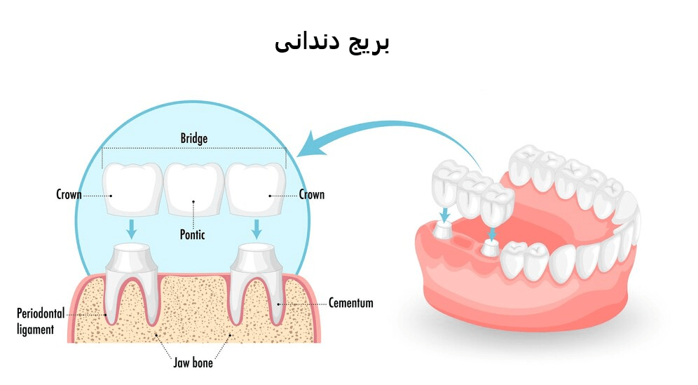 بریج دندان یا همان پل دندانی
