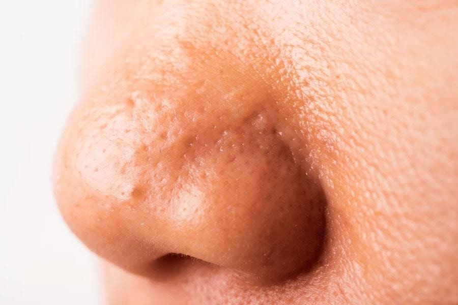 کوچک کردن بینی گوشتی با کمک گلاب