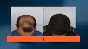کاشت مو بدون کوتاهی و تراشیدن سر