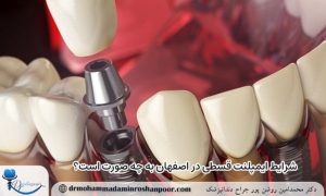 شرایط ایمپلنت اقساطی در اصفهان