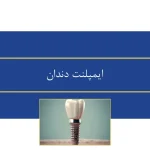 ایمپلنت دندان