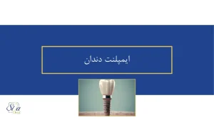 ایمپلنت دندان