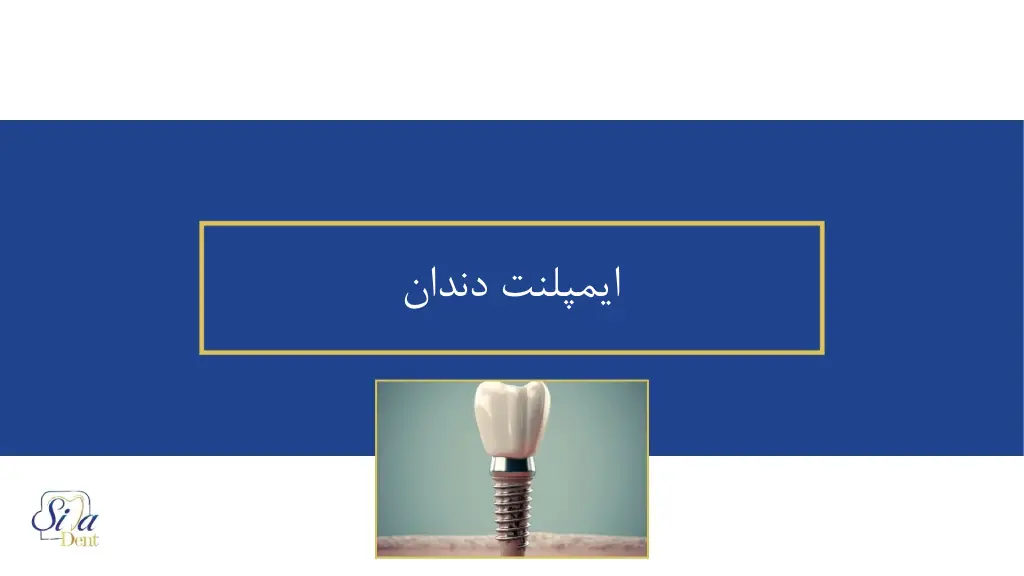 ایمپلنت دندان