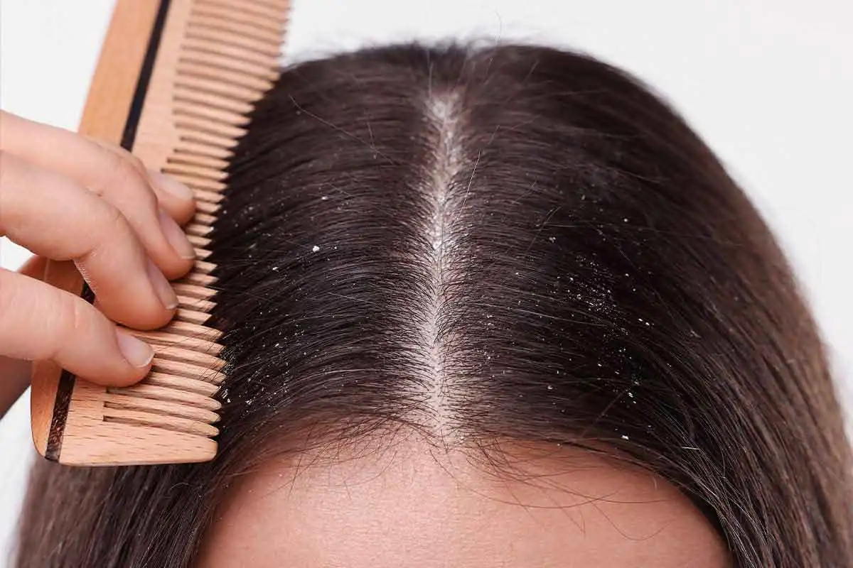 Dandruff: Causes, Types, Treatment, and Complete Prevention Guide