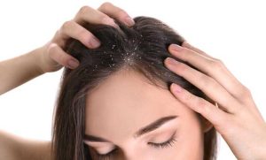 Dandruff: Causes, Types, Treatment, and Complete Prevention Guide